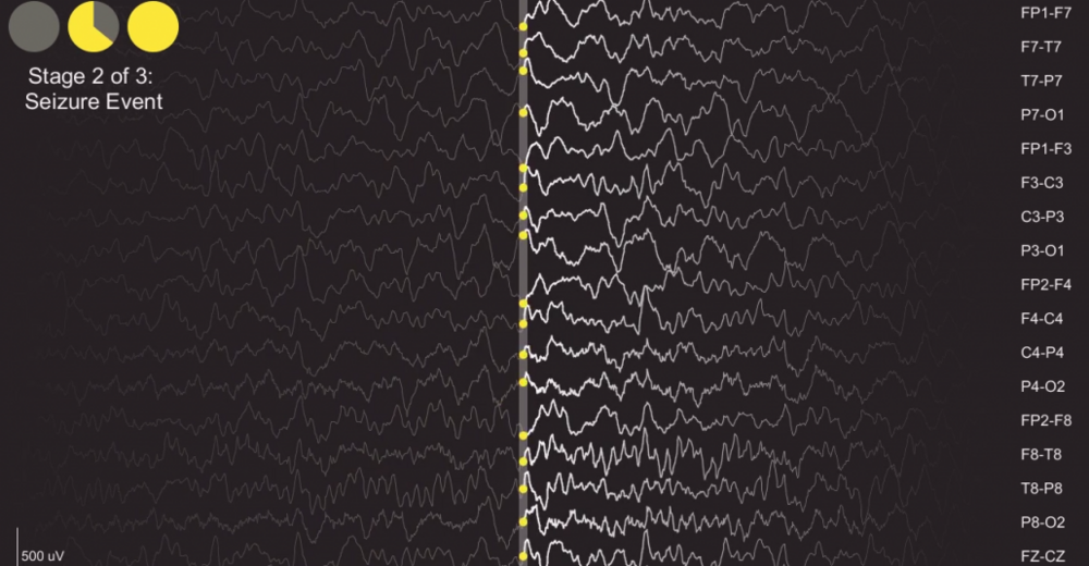 Epilepsi Nöbetindeki Beyin Dalgalarından Müzik