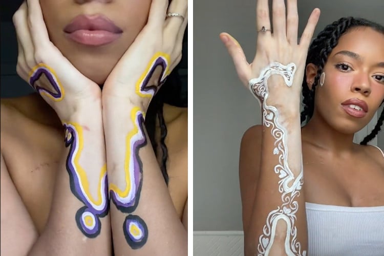 vitiligo lekeleri