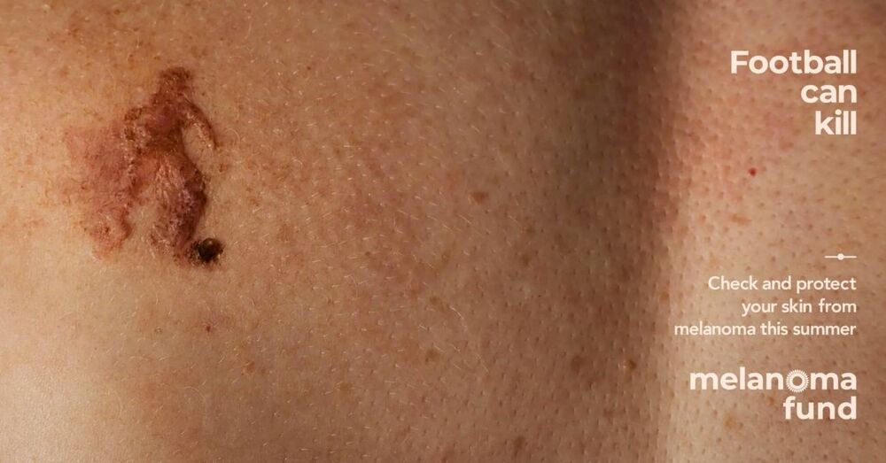 Olimpiyat Sezonunda Sportif Silüetlerle Cilt Kanserine Dikkat Çekmek